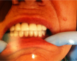 A person s open mouth with teeth, wearing blue gloves, and possibly undergoing dental work.