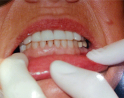 The image shows a person with visible dental work, likely a cosmetic dentistry procedure, sitting in a dental chair while receiving treatment, with a dental professional s hands holding their mouth open.