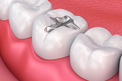 The image shows a close-up view of a human mouth with teeth, including an upper front tooth with a silver filling, against a red background which suggests a dental setting.