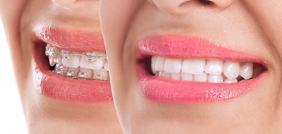 The image shows a close-up of a person s face with a smile, featuring teeth whitening, against a white background.