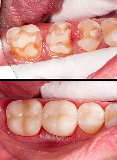 The image shows two photos side by side  an upper photo of a person s teeth with decay and staining, and a lower photo of a person s mouth after dental treatment, revealing cleaner teeth and gums.