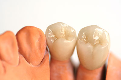 The image shows two rows of artificial teeth with visible dental implants, placed side by side against a white background.