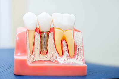 The image shows a dental model with artificial teeth, some of which have a visible screw, placed on a pink base that resembles gums.