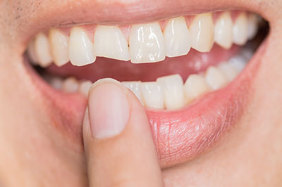 The image shows a person with a broad smile, holding their finger near their teeth, which appear clean and well-maintained.