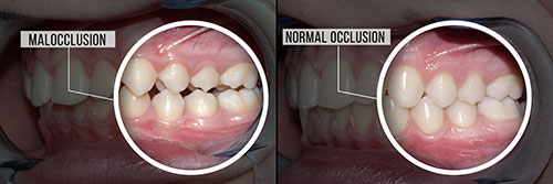 The image shows two photographs of an open mouth with dental implants and teeth, highlighting the transformation from a normal occlusion to one with malocclusion.