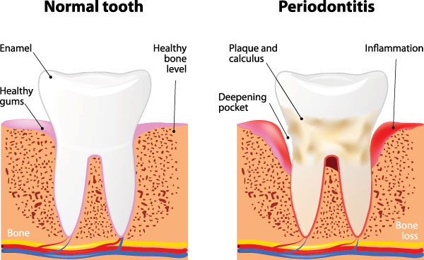 The image shows a diagrammatic representation of a tooth with different levels of gum disease progression labeled  Normal,   Periodontitis,  and  Bone loss.  It illustrates how healthy teeth have pink gums, while diseased teeth show signs of inflammation and bone erosion.