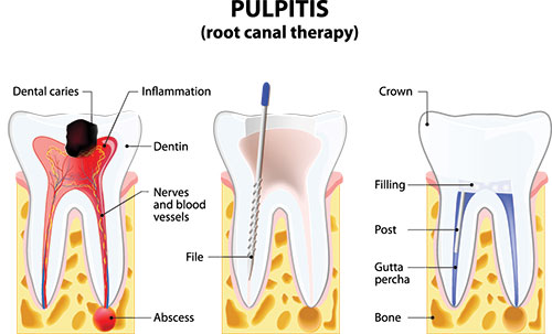 The image depicts a detailed diagram of a tooth with pulpitis, including annotations such as  root canal therapy,   dental caries,   inflammation,   crown,   filling,   tooth vials,  and  absorb.  It illustrates the internal structure of a tooth affected by pulpitis, showing the tooth s layers and the presence of bacteria.