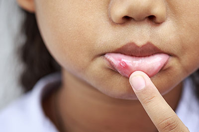 A young girl with pimples on her face, holding her finger to her lips.