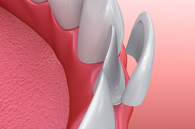 The image shows a close-up of a dental implant fixture with teeth crowns attached, set against a medical background with a focus on oral health care.