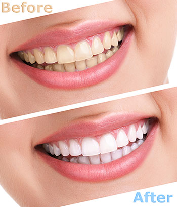 The image shows a before-and-after comparison of teeth whitening, with two photos side by side  one showing a person s teeth with stains, and the other displaying the same individual s teeth after a teeth whitening treatment, revealing a noticeable improvement in brightness.